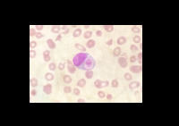 Platelet phagocytosis by a peripheral blood monocyte in a patient with ...