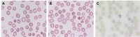 A case of Mediterranean Stomatocytosis/macrothrombocytopenia with moderate anemia
