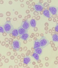 marginal-zone-b-cell-lymphoma-blood-smear