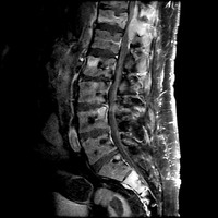 MRI myeloma