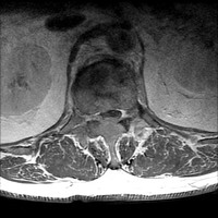 MRI myeloma