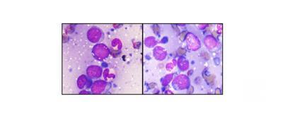 Abnormal lymphoid cells in bone marrow aspirate and imprint smears