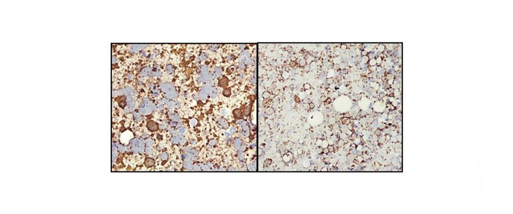 Immunohistochemistry for CD20 and CD 10 on destained bone marrow imprintsImmunohistochemistry for CD20 and CD 10 on destained bone marrow imprints
