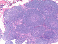 Mantle Cell Lymphoma Histology