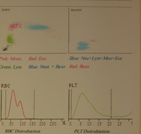 Dimorphic anemia presentation in patient with iron deficiency 2