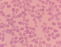 iron deficiency anemia slide