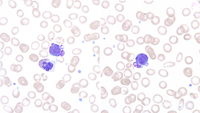 Peripheral blood smear, 2015, lymphoid cells with nuclear budding