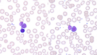 Peripheral blood smear, 2019, lymphoid cells with nuclear budding