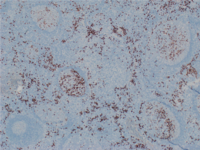 CD138 positive plasma cells in the germinal center and interfollicular region
