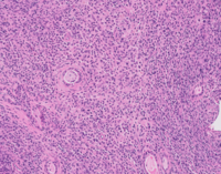 Myeloid Sarcoma H&E