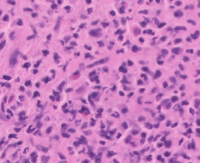 Myeloid Sarcoma H&E High Power