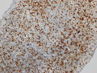 Myeloid Sarcoma MPO