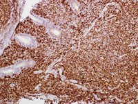 MALT/Extra-Nodal Marginal Zone Lymphoma Bcl2