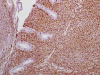 MALT/Extra-Nodal Marginal Zone Lymphoma CD43
