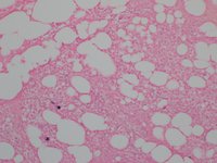 Lambda insitu hybridization: only rare plasma cells are lambda light-chain positive.