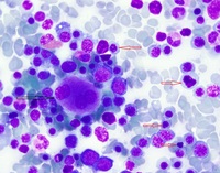 Multilineage dysplasia including dysplastic megakaryocyte with separate nuclei (black arrow) and dysplastic erythroid precursors (red arrows)