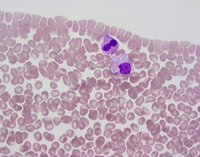 Peripheral smear showing neutrophil and monocyte with prominent reactive features, such as toxic granules and cytoplasmic vacuolization.