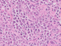 High power image showing atypical lymphocytes characterized by monomorphic population of intermediate-sized cells.