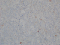 Burkitt Lymphoma Bcl-2