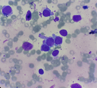 Metastatic Neuroblastoma Aspirate Smear