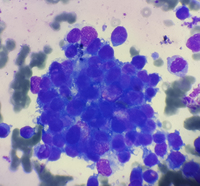 Metastatic Neuroblastoma Aspirate Smear High Power