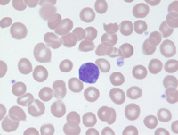 Mycosis-Fungoides-Blood