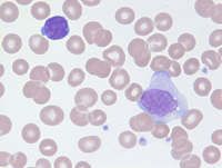 Mycosis-Fungoides-Blood