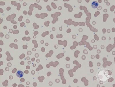 Rouleaux in Myeloma