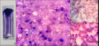 A matter of staining? Bone marrow necrosis in young male patient