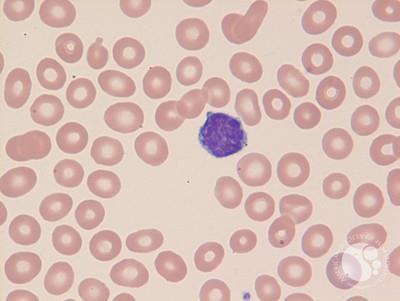 Splenic Marginal Zone Lymphoma-Blood