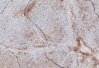 Splenic-Marginal-Zone-LymphomaBlood