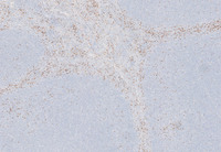 Splenic-Marginal-Zone-LymphomaSpleen