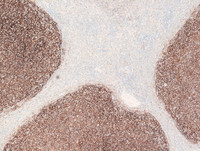 Splenic-Marginal-Zone-LymphomaSpleen