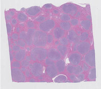 Splenic Marginal Zone Lymphoma-H&E