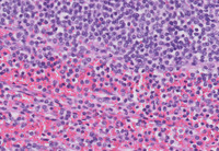 Splenic Marginal Zone Lymphoma-H&E