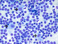 Splenic Marginal Zone Lymphoma-Touch Preparation