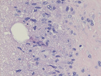 Cat-Scratch-DiseaseHE-High-Power