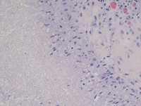 Cat-Scratch-DiseaseHE-Intermediate-Power