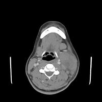Sinus Histiocytosis with Massive Lymphadenopathy (SHML)