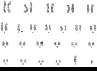 Refractory Cytopenia of Childhood