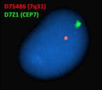 Refractory Cytopenia of Childhood