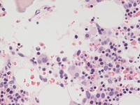 Refractory Cytopenia of Childhood