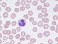 Refractory Cytopenia of Childhood