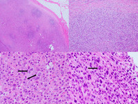 Anaplastic Large Cell Lymphoma ALK+