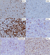 Anaplastic-Large-Cell-Lymphoma-ALK-IHC