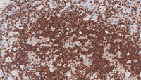 Germinotropic Lymphoproliferative Disorder-CD79