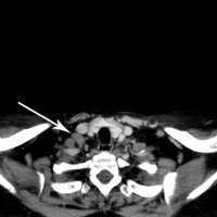 Follicular Lymphoma Grade 3a-CT Scan