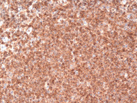 Follicular-Lymphoma-Grade-3aBCL2