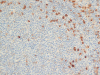 Follicular Lymphoma Grade 3a-CD10