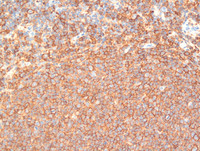 Follicular Lymphoma Grade 3a-CD20